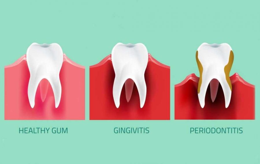 heathy vs gingivitis gums periodontal disease