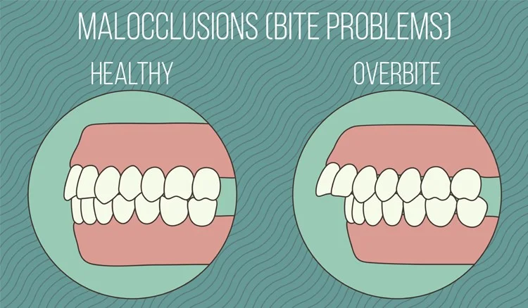 Causes of Dental Crown Pain, Remedies to Relieve it. Royal Dental Clinics Occlusion balance - Complete Open Bite Correction