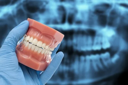Kind of Dental Implant X-ray required before Dental Treatment Royal Dental Clinics dental xray