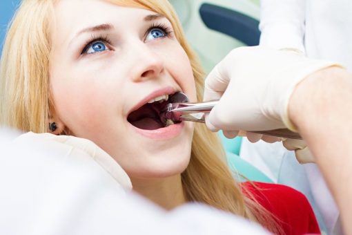 dental extraction