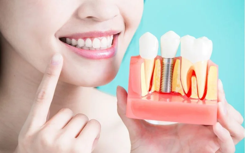teeth implant in one day - Tooth Implantation