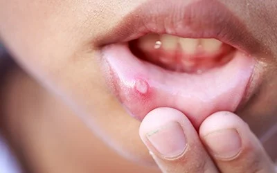 oral ulcer | gum boil after root canal