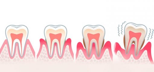 Treatment-for-Tooth-Mobility