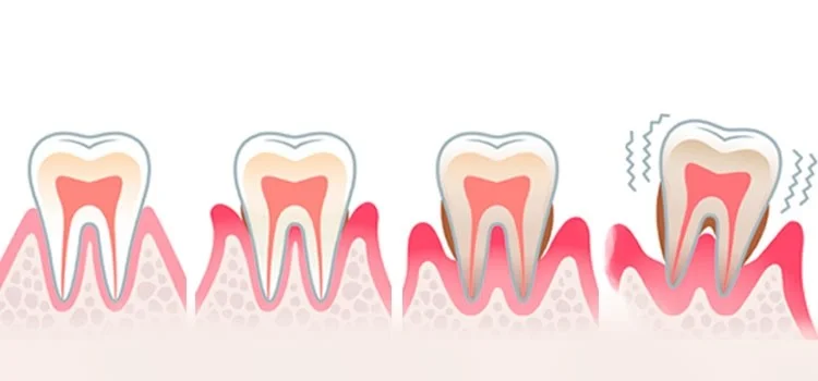 Teeth Mobility in Kandivali, Mumbai: How Gum Disease Affect Smile Royal Dental Clinics tooth mobility