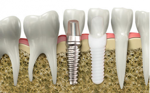 zirconium dental implants