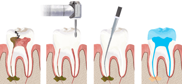 single-sitting-root-canal