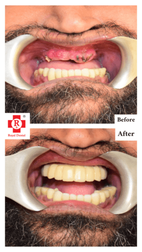 Front Tooth Implants