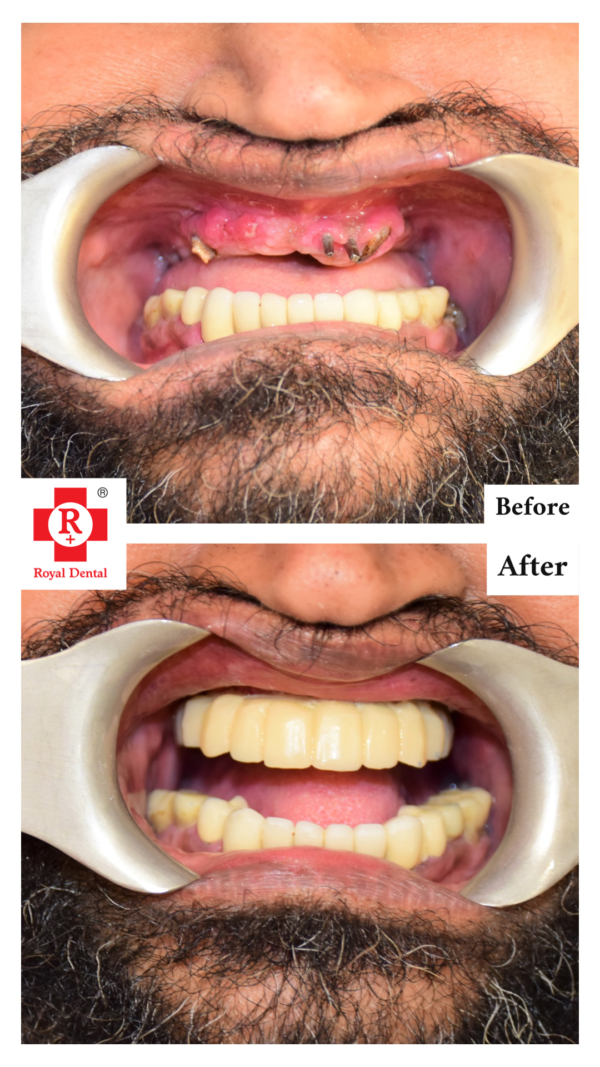 Front Tooth Implants