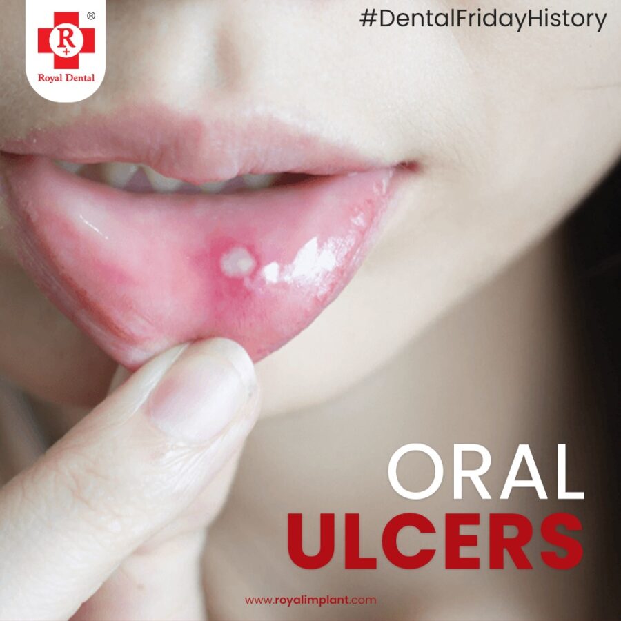 oral ulcers