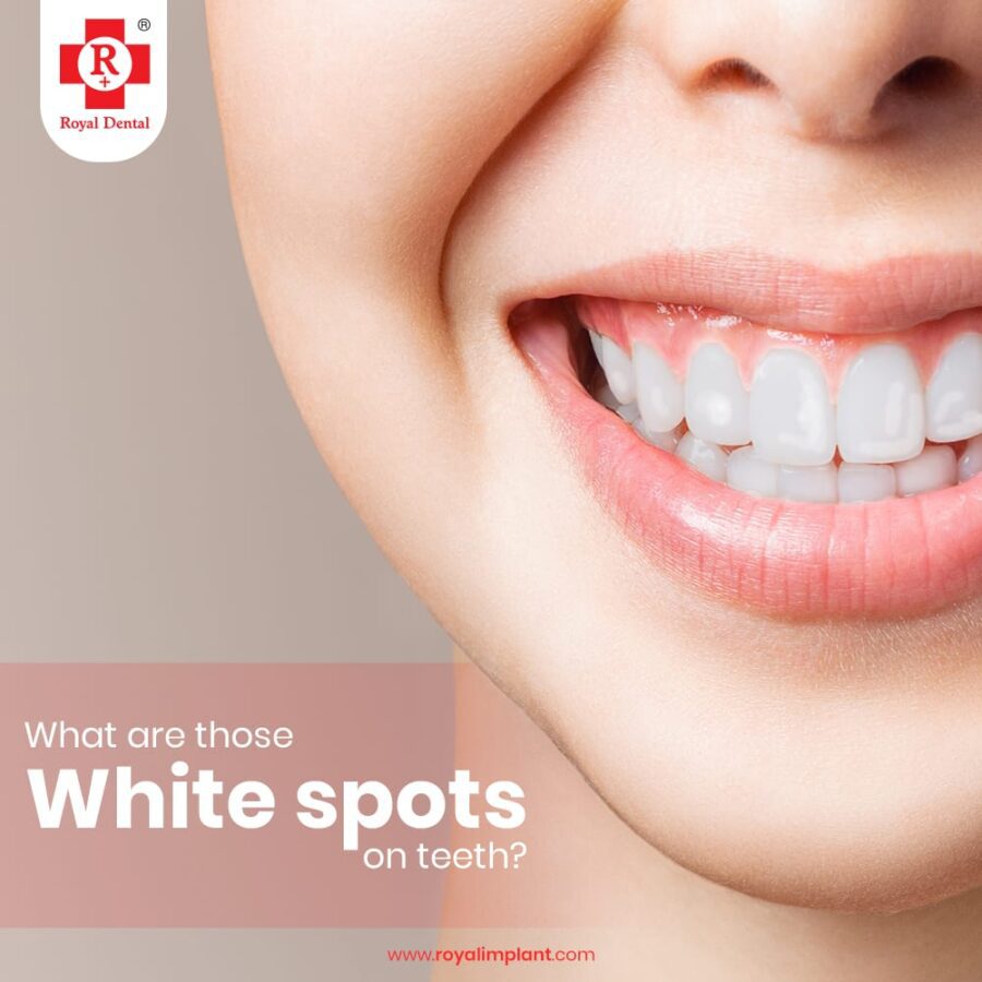 Prevent Calcium Deposits on Your Teeth Royal Dental Clinics white spots on teeth