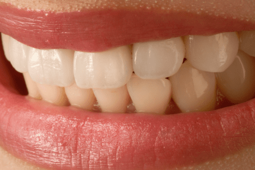 teeth veneers and crowns