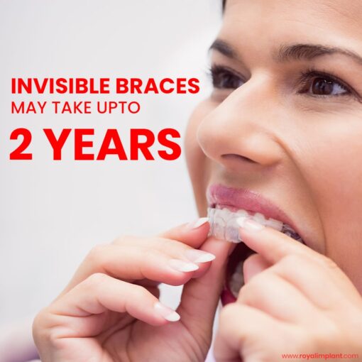 invisible braces for teeth straightening