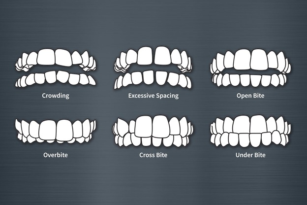 types of crooked teeth in adults