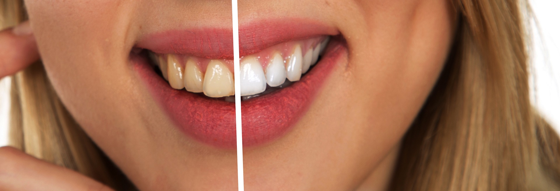 Women before and after teeth cleaning