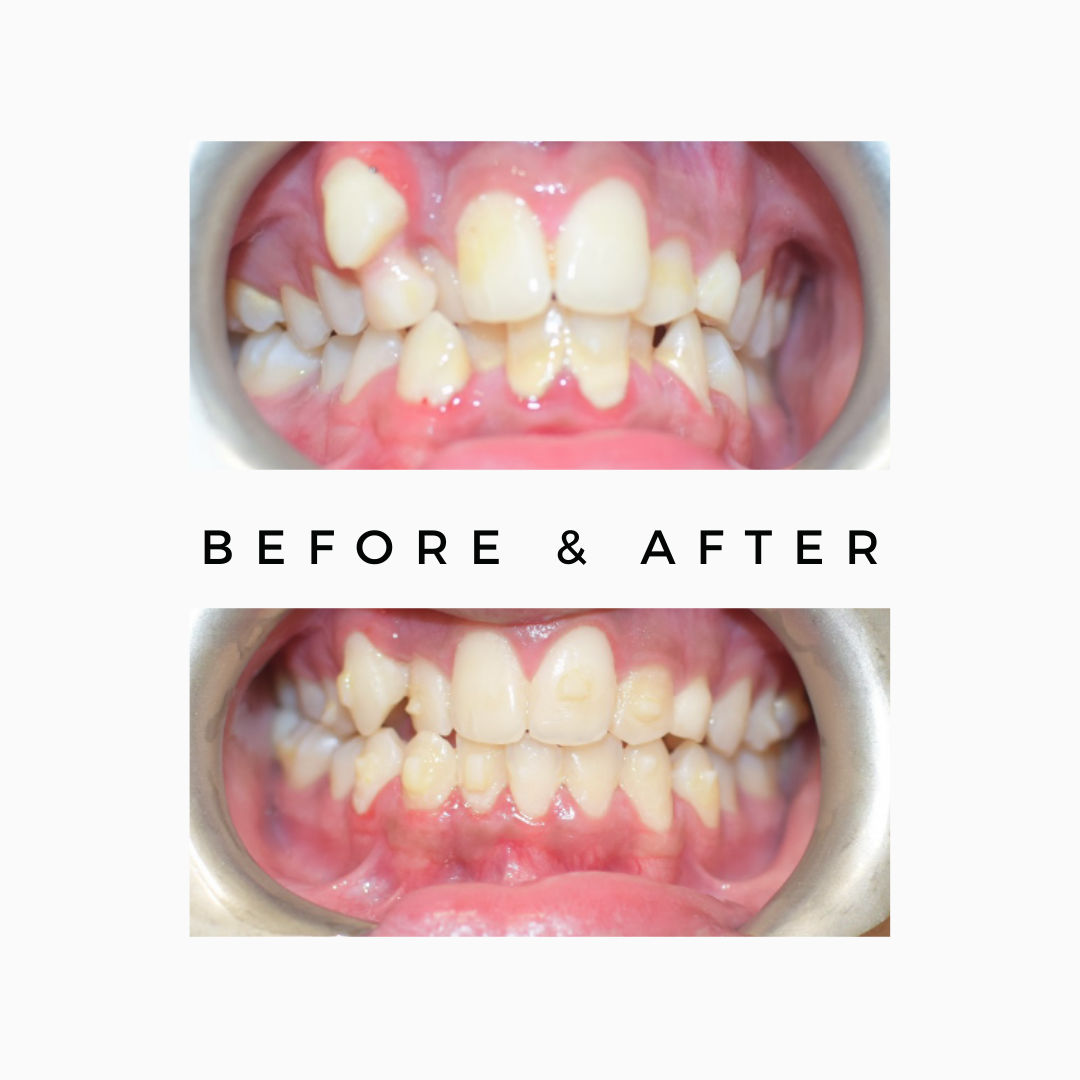 Crooked teeth in children