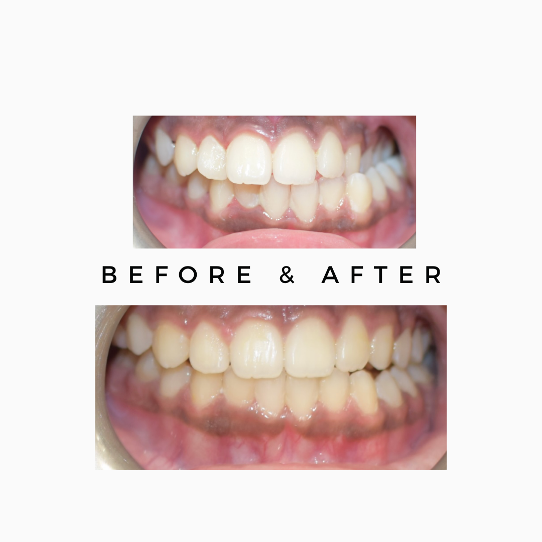 Smile Alignment Treatment