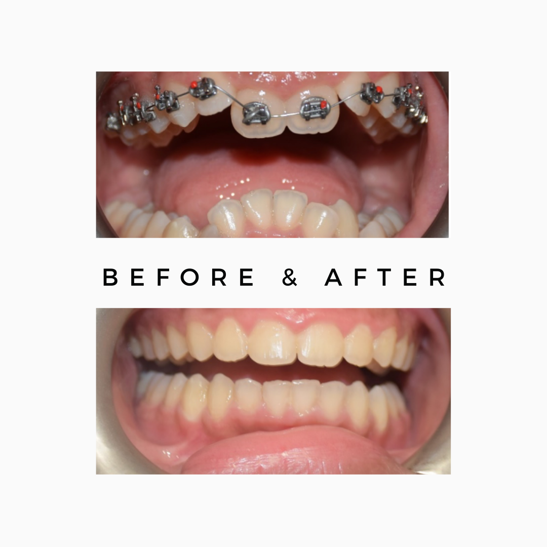 Braces Wires Treatment