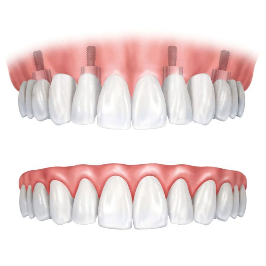 denture-vs-dental-implant