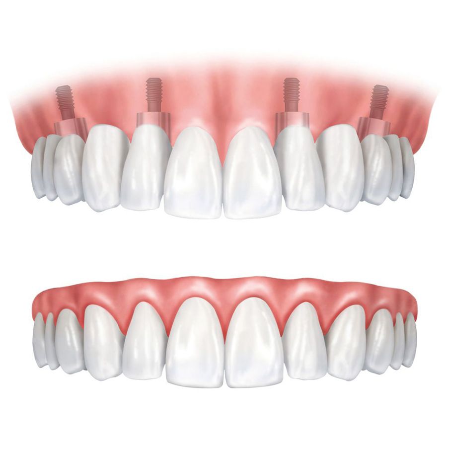 denture vs dental implant