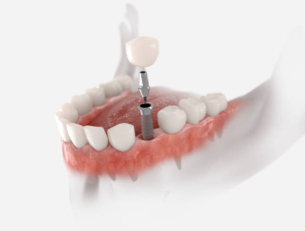 revolutionary dental implant