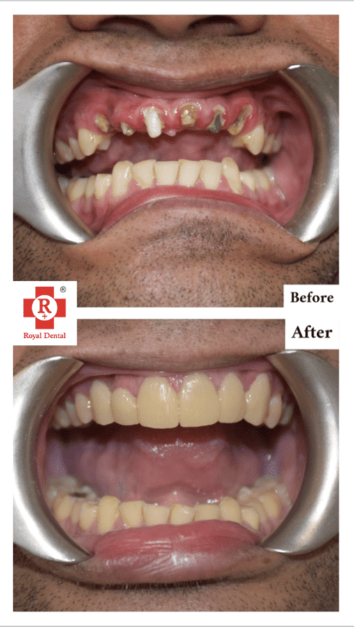 Multiple Missing Teeth
