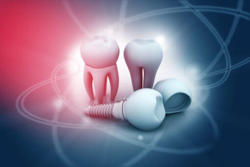 Dental Implants Are Needed