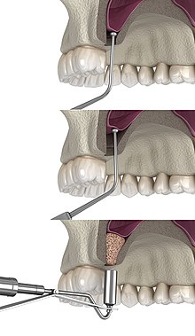 Oral and Maxillofacial surgeons sinus lift