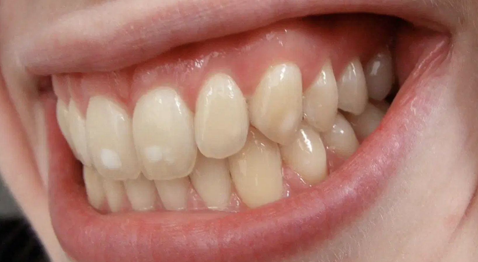 white spots on tooth