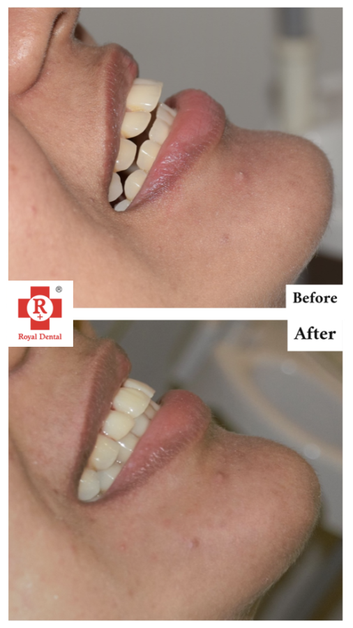 Protrusion in Teeth