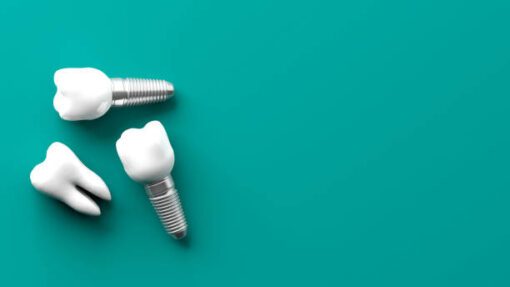 suitable for dental implants for upper teeth