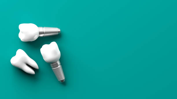 dental implants for upper teeth