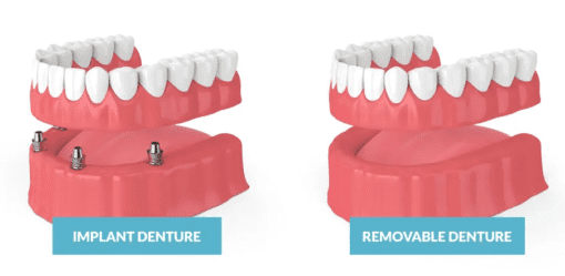 types of dentures - Fixed Teeth vs Removable Dentures