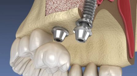 sinus lift with bone graft