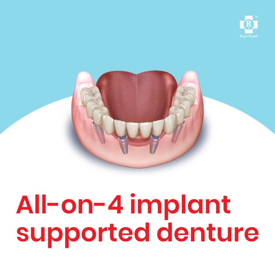 implant supported dentures with artificial teeth