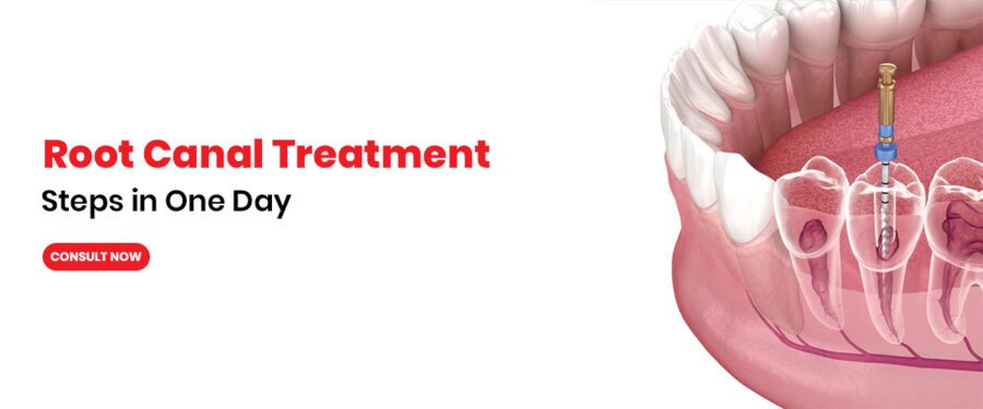 Root Canal Treatment Steps