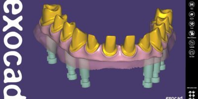 digital smile design exocad