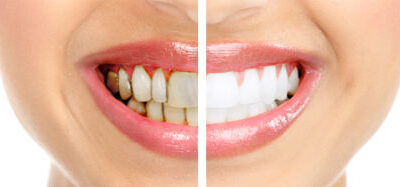 Teeth whitening before after
