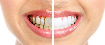 Teeth whitening before after