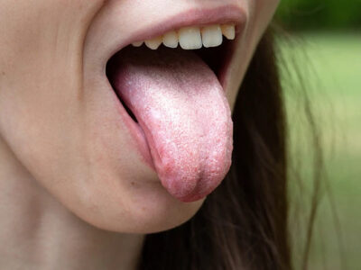 white layer over tongue