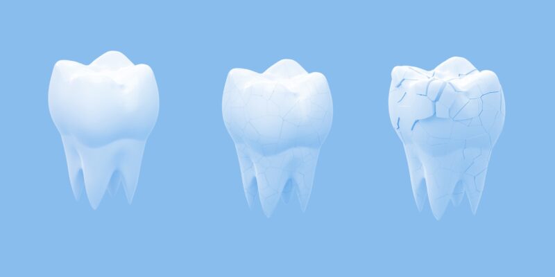 Are Dental Implants Permissible in Islam? Islamic View Royal Dental Clinics Tooth Erosion Brittle - Artificial Teeth