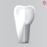 dental and zygomatic implant