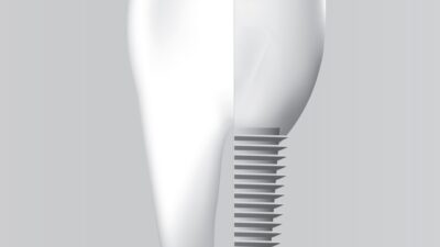 dental and zygomatic implant