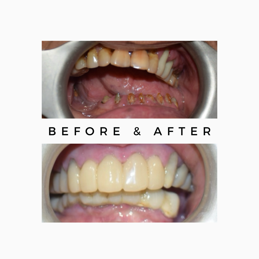 Full Mouth Dental Implants Royal Dental Clinics Oral Cancer Fixed Teeth | Dental Implants After Oral Cancer Surgery