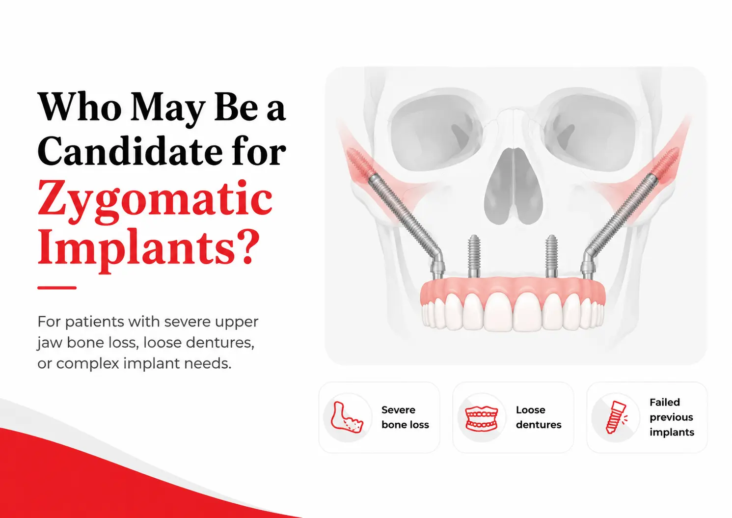 Candidate - Zygomatic Implant - suitable for Dental implants