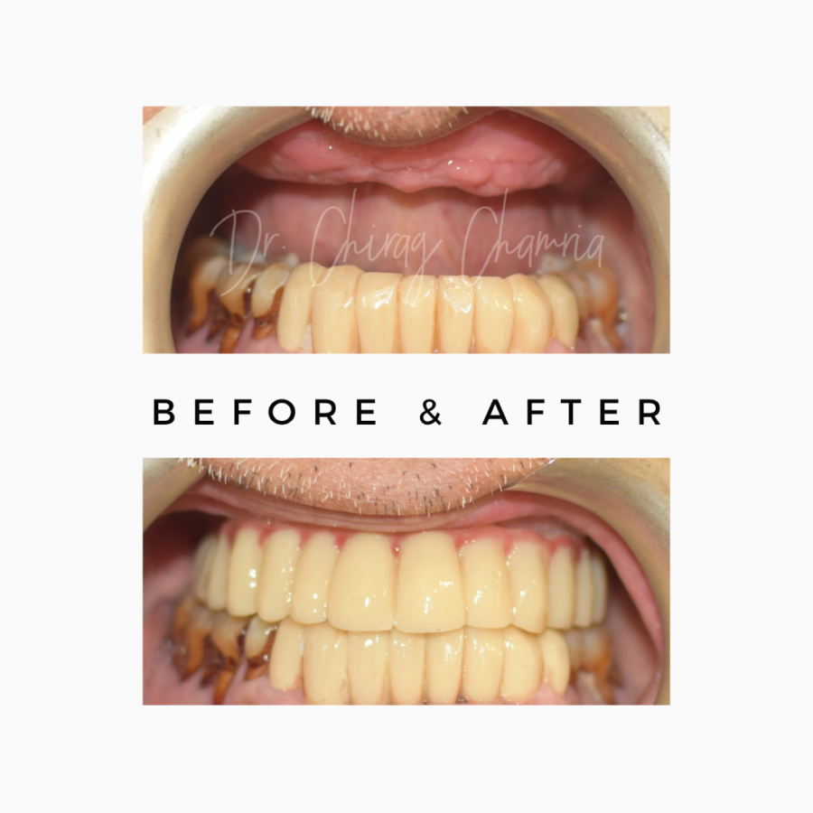 What is an Oral Cancer Screening? Royal Dental Clinics Teeth After Cancer Surgery in Mumbai