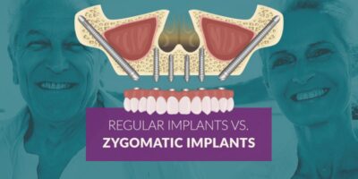 all-on-4 with zygomatic implants