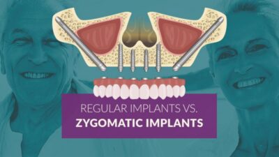 all-on-4 with zygomatic implants