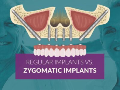 all-on-4 with zygomatic implants