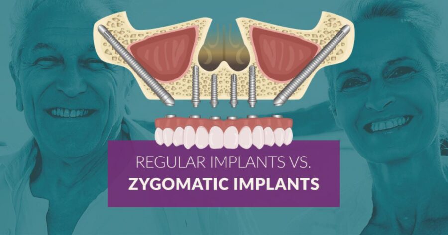 all-on-4 with zygomatic implants