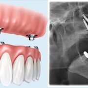 zygomatic implant dentures
